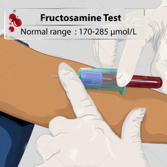 serum fructosamine test